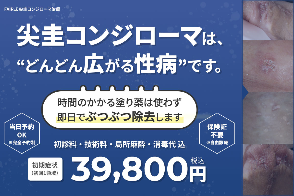 尖圭コンジローマ初期症状なら39,800円～即日治療！